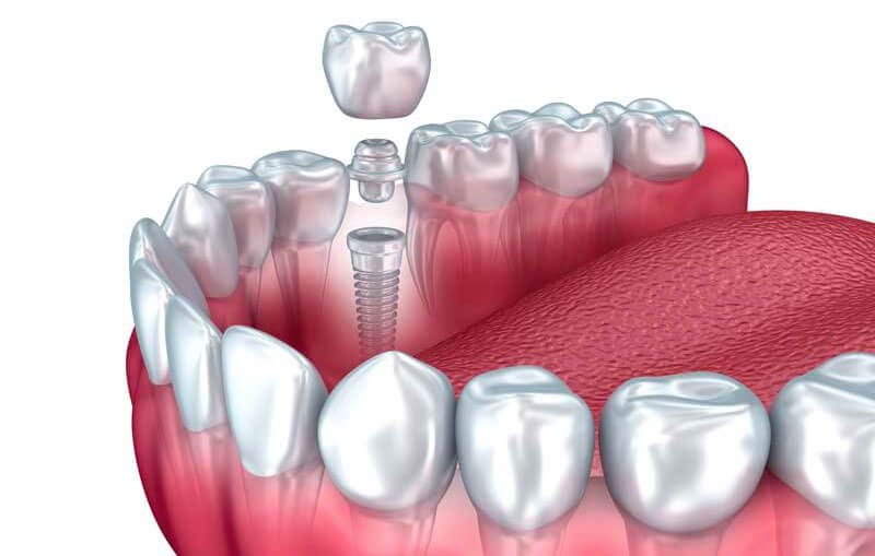 Traditional Dental Implants in Waltham